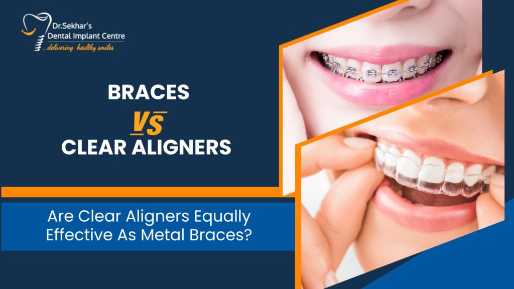 Braces Vs Clear Aligners: Are Clear Aligners Equally Effective As Metal Braces?
