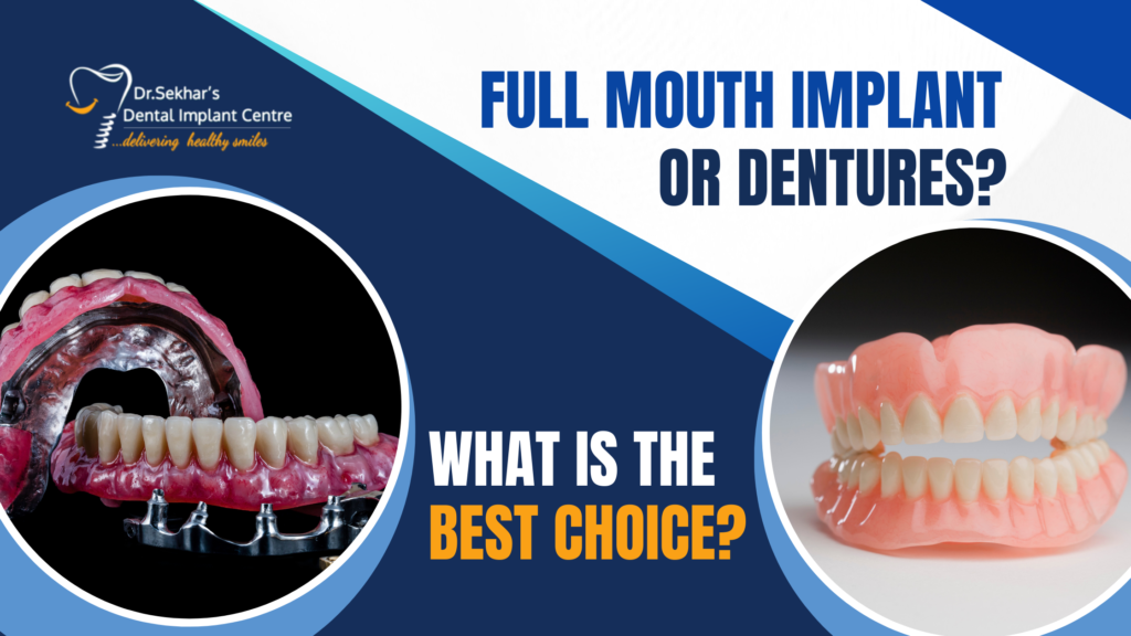 Full Mouth Implants or Dentures: What’s Right for You?